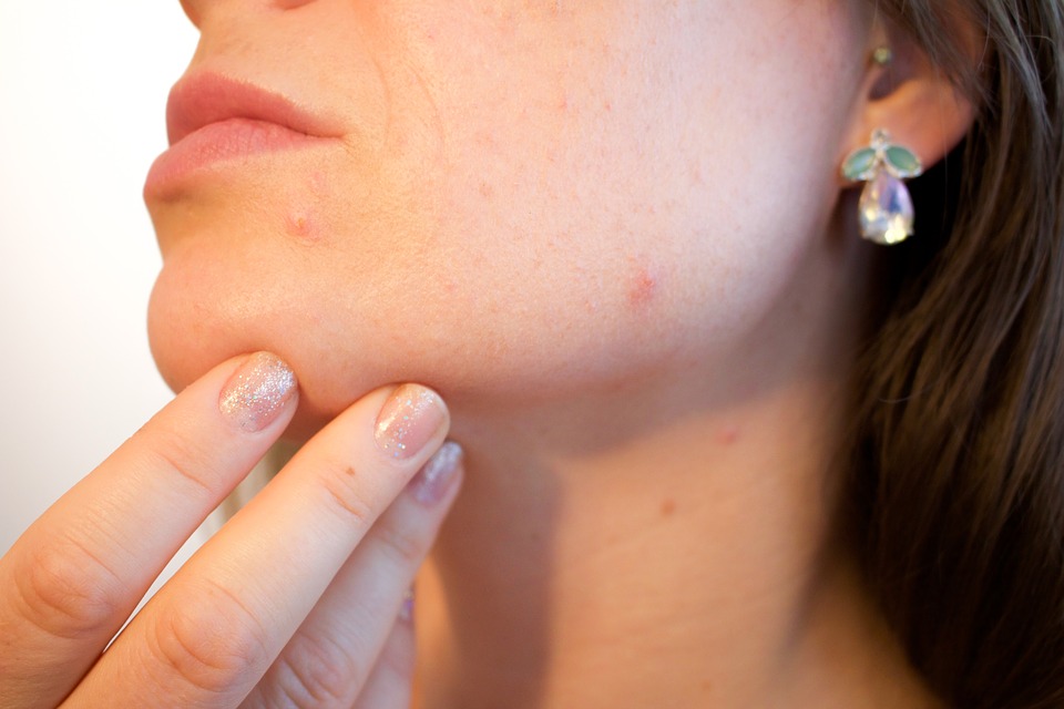 Traitements contre l'acné